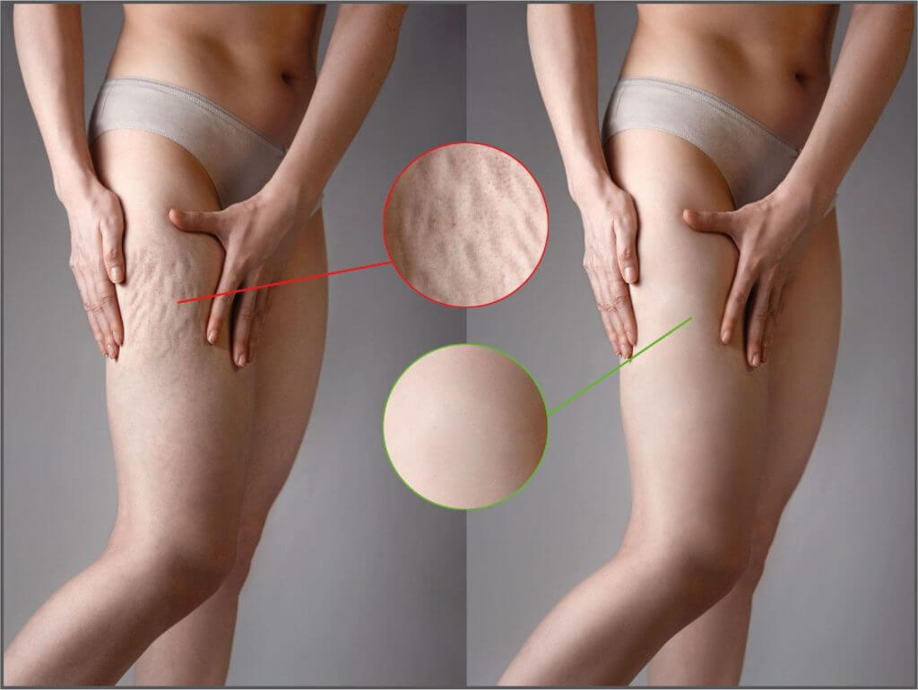 Fig. 3 - Cellulite Pathology Before and After